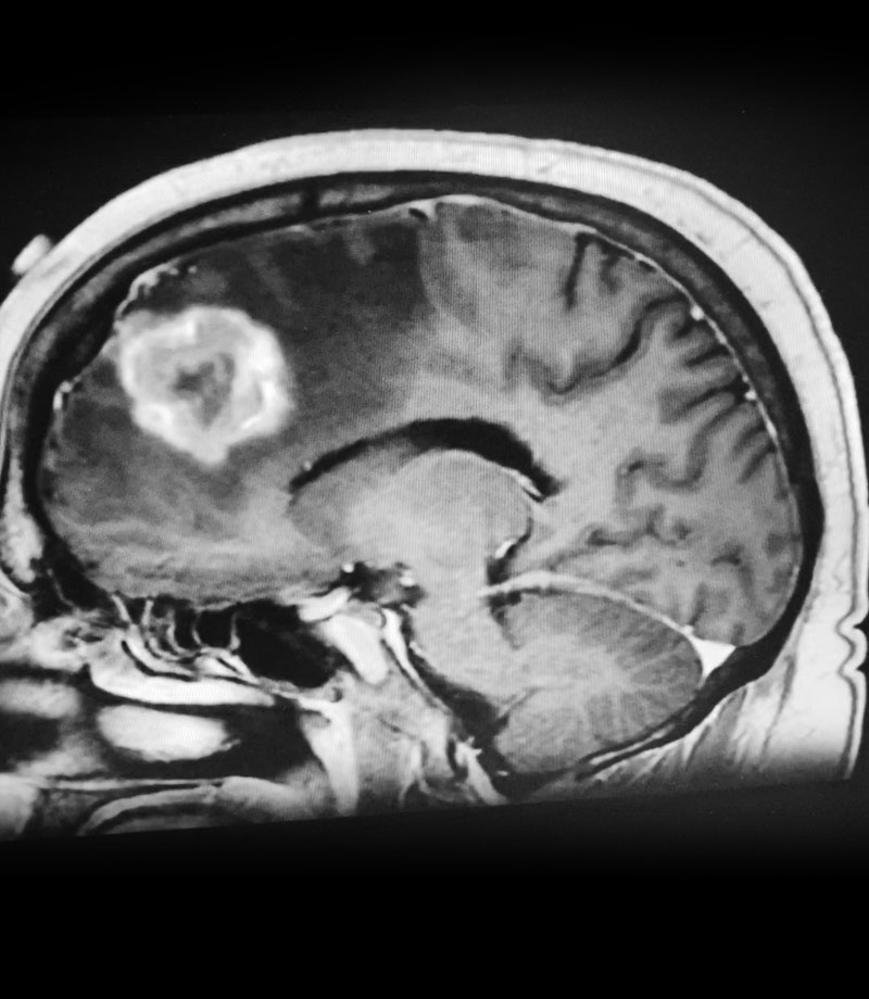 Sagittal post-contrast MRI