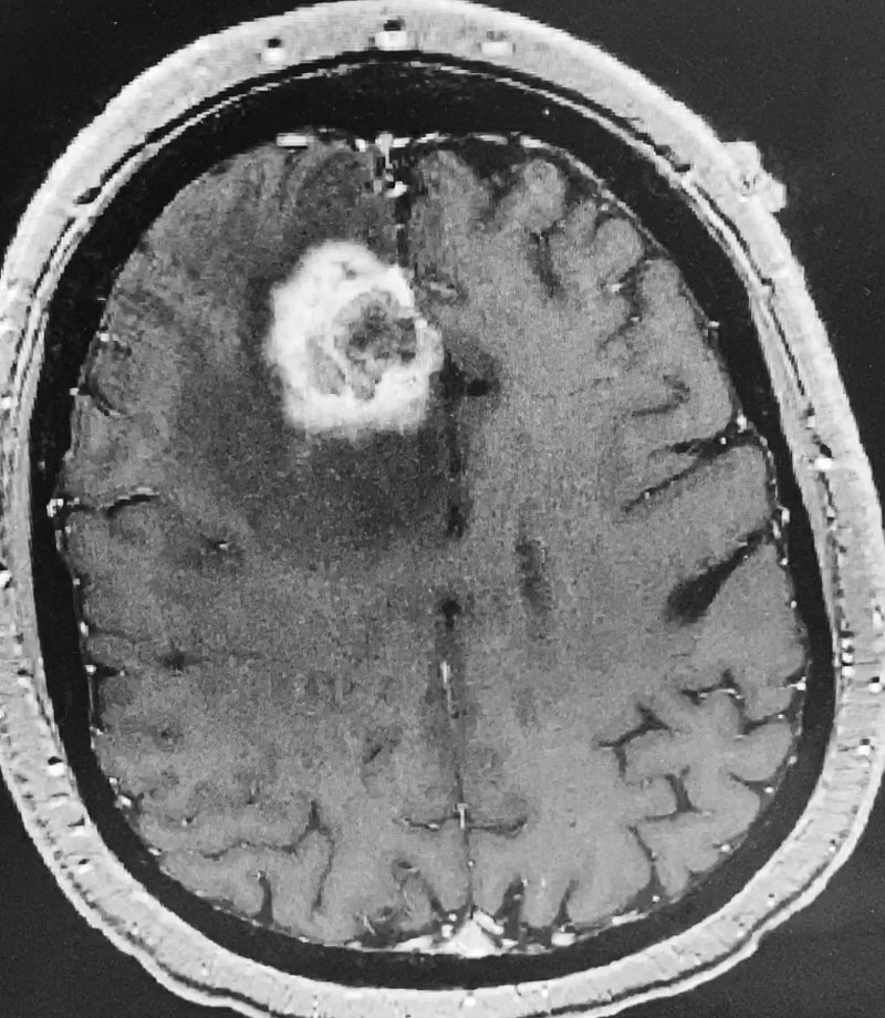 Axial post-contrast MRI