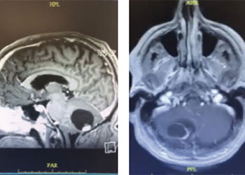 Cerebellar Hemangioblastoma feature