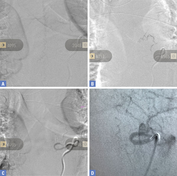 Pre-Treatment (Figure 2A and 2D), At Treatment (Figure 2B - Onyx Glue Cast), and PostTreatment (Figure 2C)