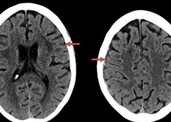 Middle Meningeal Artery Embolization Feature