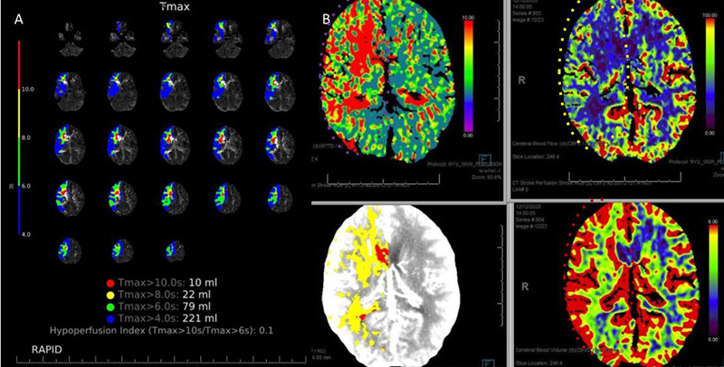 A) CT Brain Prefusion Tmax confirms delayed flow; B) MTT, CBF, CBV and Hybrid Threshold Parametric Maps of Right MCA/ACA revealing diminished CBF, elevated CBV, and prolonged MTT of at-risk Ischemic Tissue