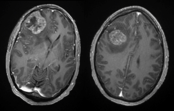 Cerebral Metastases from Non-Small Cell Lung Cancer 1