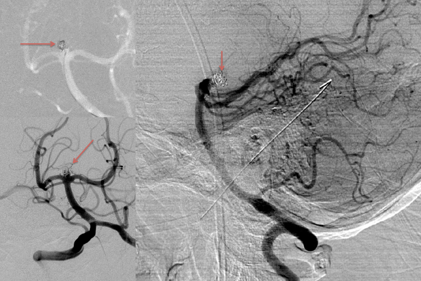 Man in 40’s with progressive confusion and headaches 3