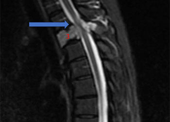 Spinal Embo feature