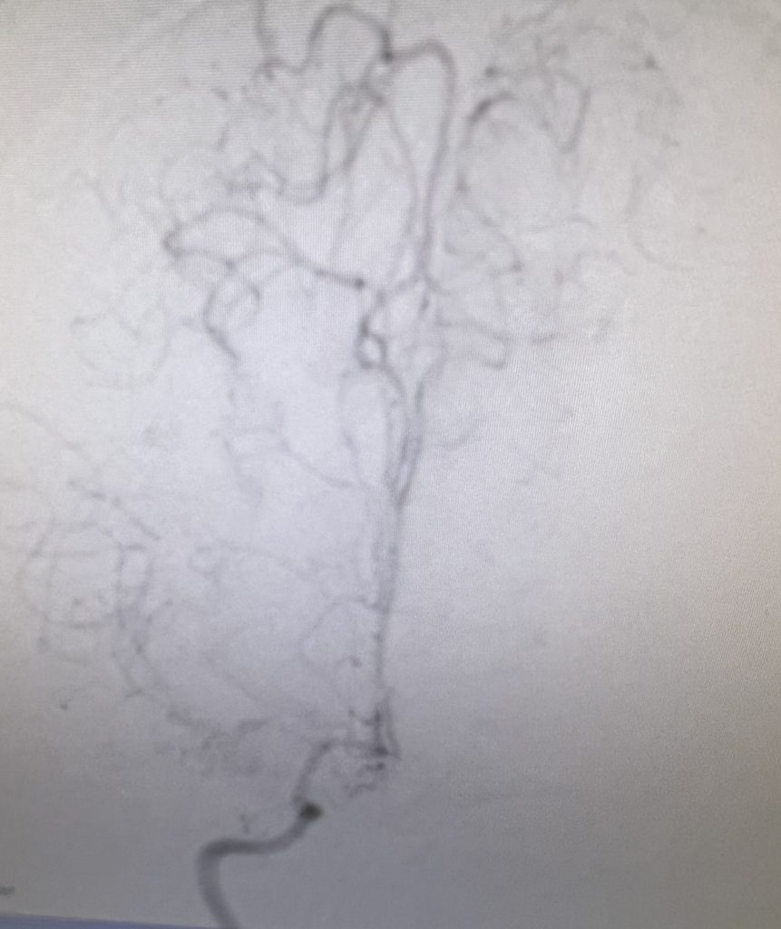 Indirect EDAS Revascularization Treats Moya-Moya Syndrome 1