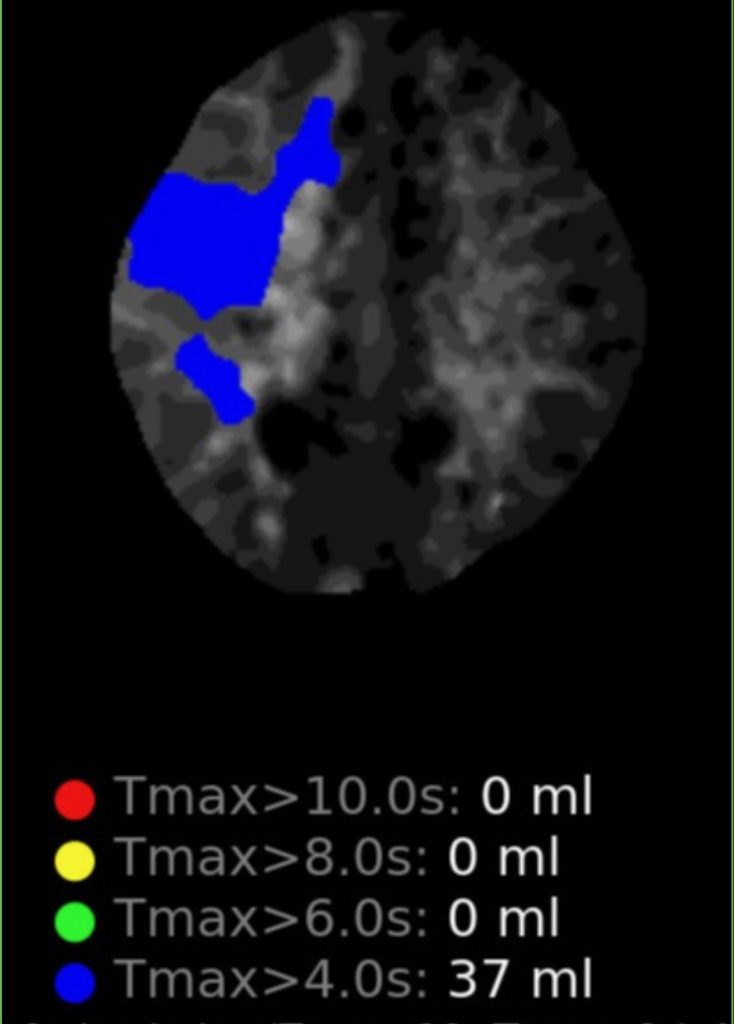 Indirect EDAS Revascularization Treats Moya-Moya Syndrome 2