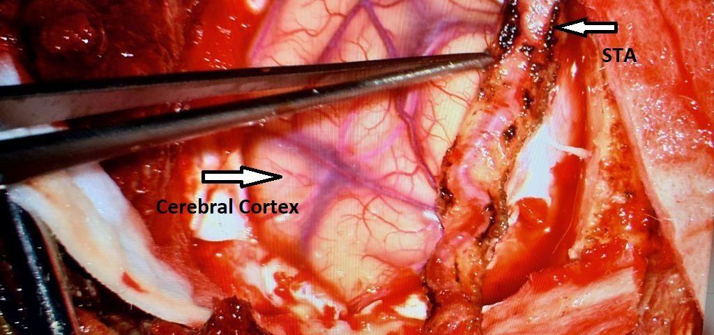 Dr. J. Brisman EDAS Case Summary Fig. 3 Image At Treatment Completed Right Sided EDAS Procedurefinal 2