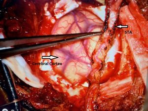 Indirect EDAS Revascularization Treats Moya-Moya Syndrome 3