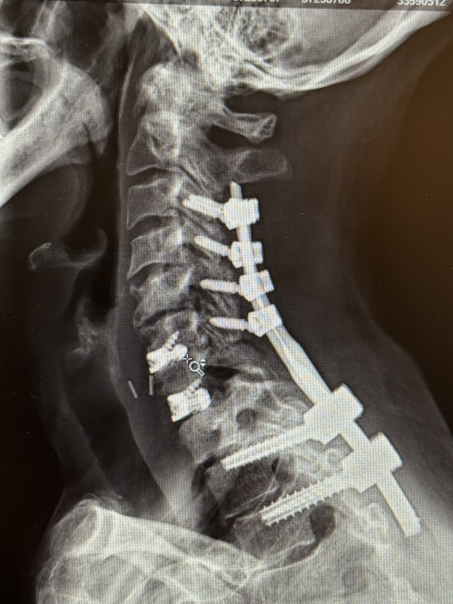 BRC Case Study - Pre-op Photo Fig. 2